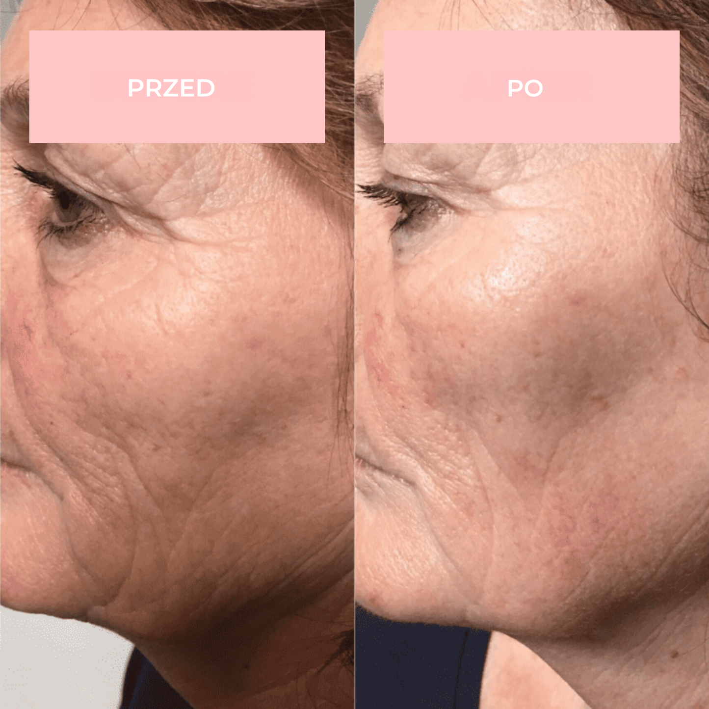 Urządzenie Glow Lane do terapii skóry wysoką częstotliwością